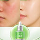 ANUA AZELAIC ACID 10+hyaluron redness soothing serum The Pretify